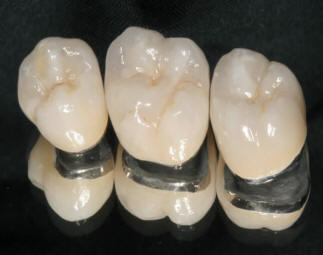 Fémkerámia koronák (hidak) készítése. www.pannoniadental.hu