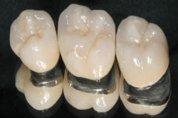 Fogorvosi rendelőnkben készítünk klasszikus fém vázra égetett porcelán leplezésű (teljes leplezés) koronákat, hidakat. www.pannoniadental.hu