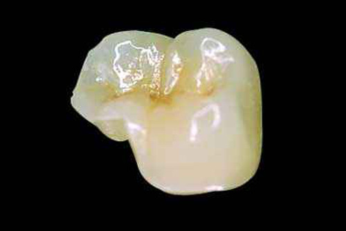 Porcelán betétek, inlay és onlay. www.pannoniadental.hu