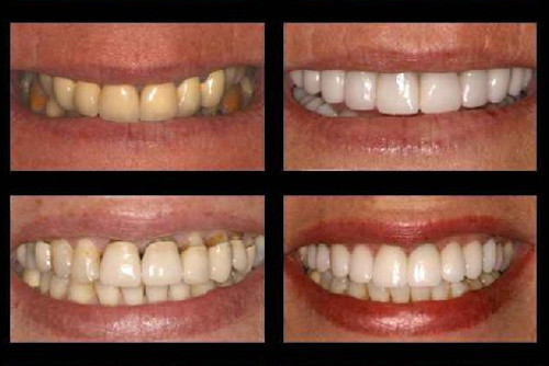 Porcelán héjak. www.pannoniadental.hu